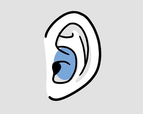 耳の耳かくの大部分を欠損したもの
